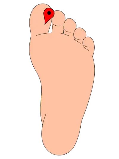Illustration of a foot with a red dot on the big toe